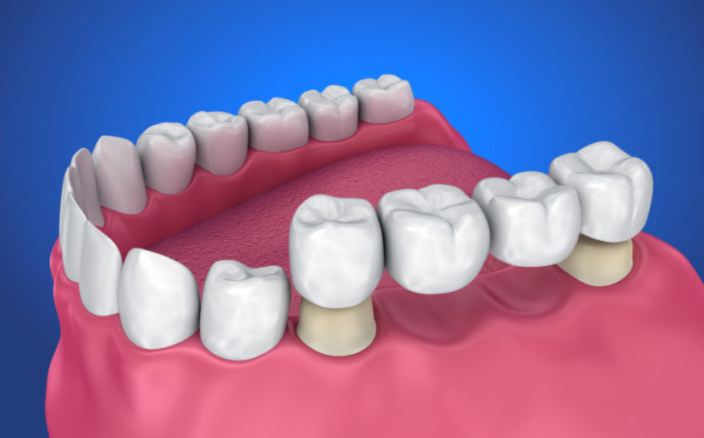 4 Types of Dental Bridges Procedure Costs FindaDentist.us