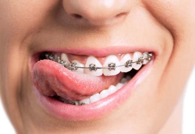 What is an Orthodontist A guide from FindaDentist.us